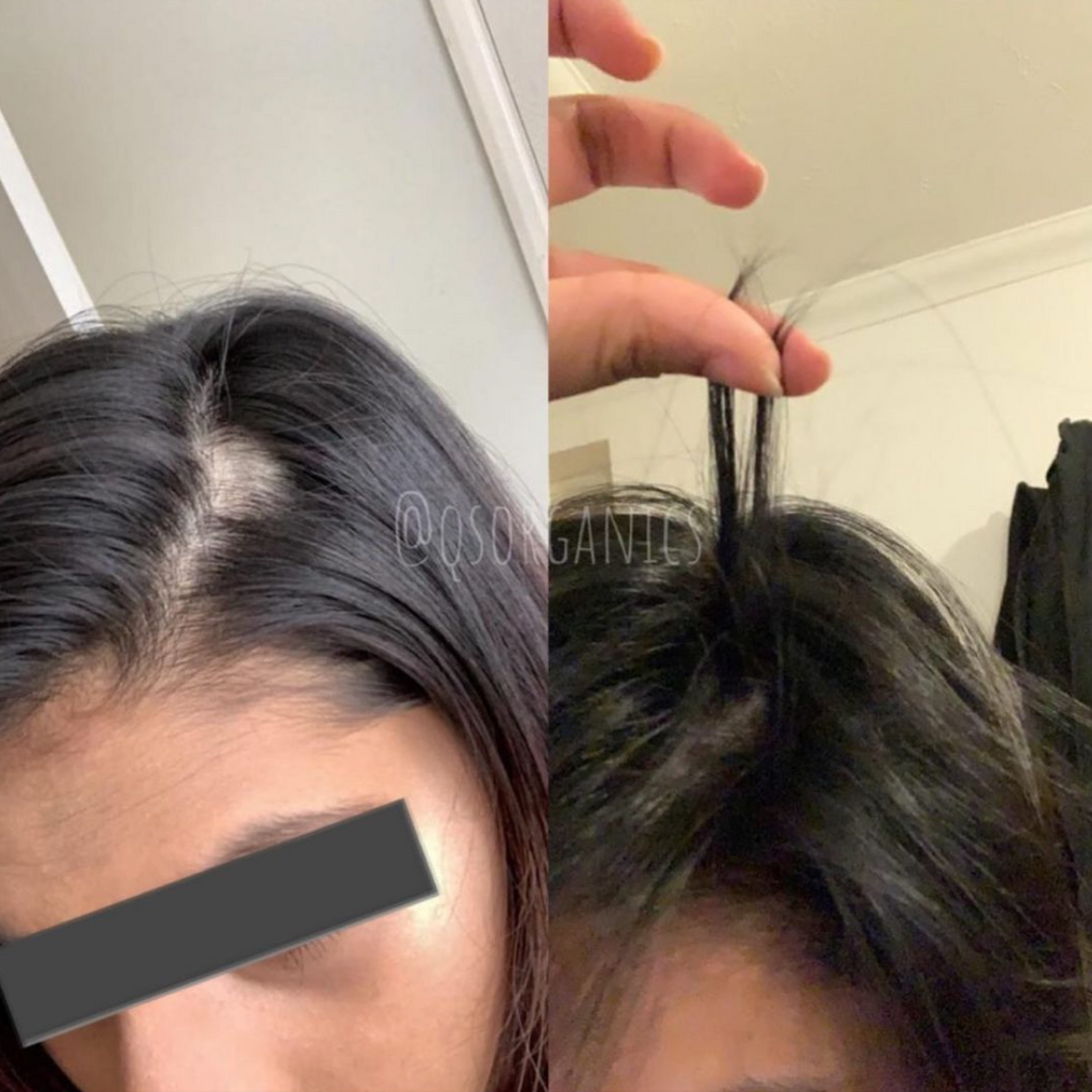 Alopecia patch before and after