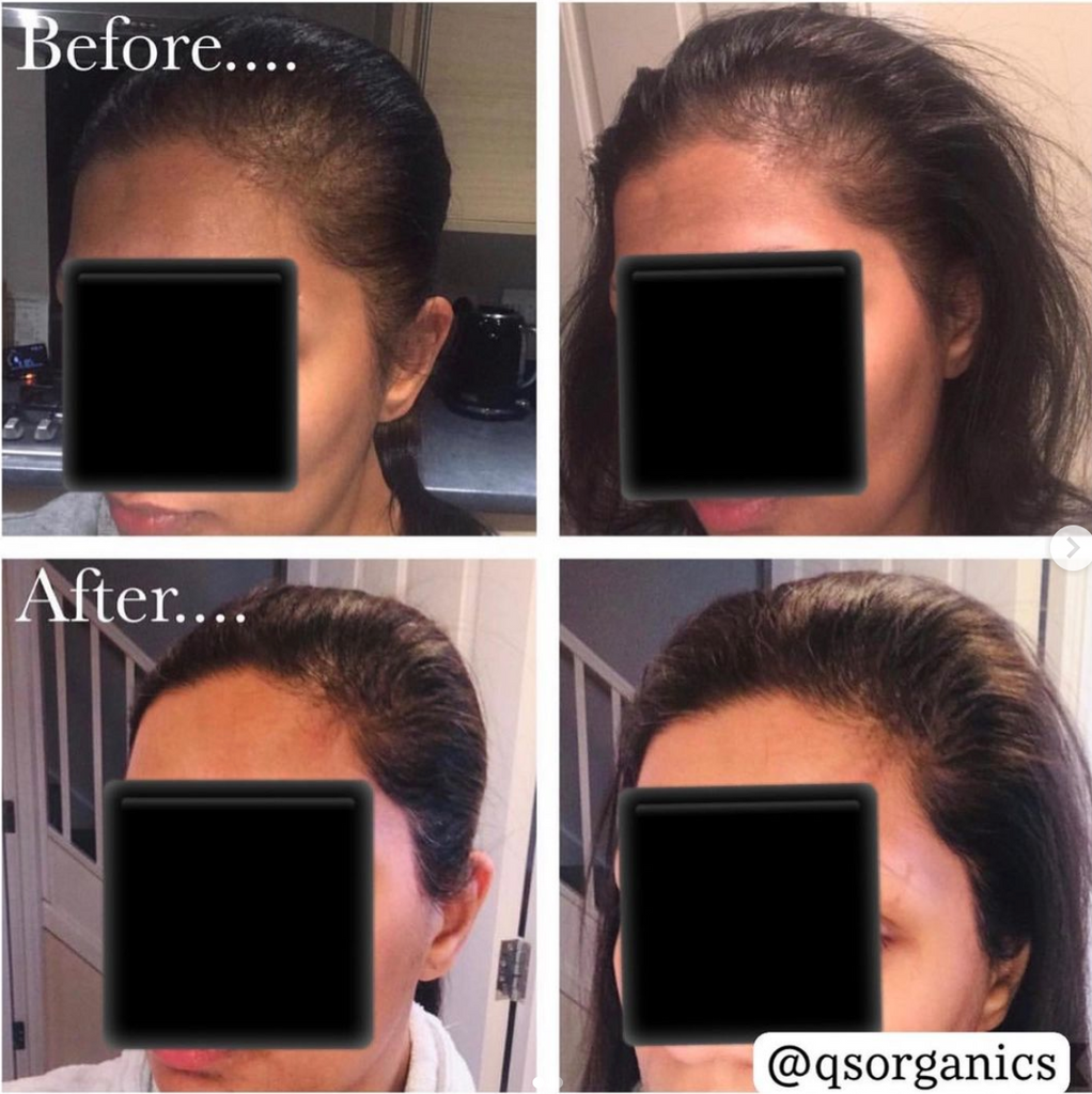 Postpartum hair loss before and after