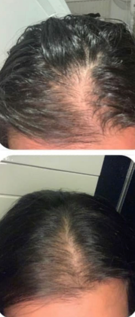 Hairline Progress